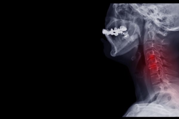 artrosis cervical tiene cura