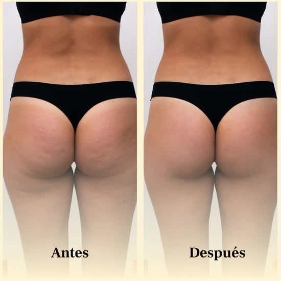 Antes y después Aceite Masajeador Anticelulítico – mejora visible de la textura en glúteos