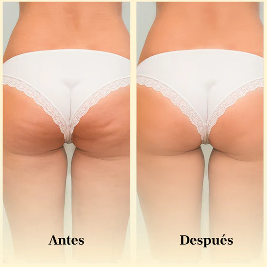Antes y después Aceite Masajeador Anticelulítico – piel más firme y uniforme en muslos