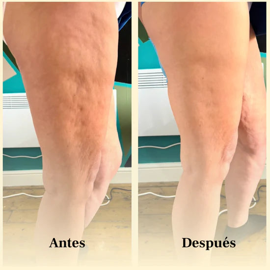 Antes y después Aceite Masajeador Anticelulítico – reducción de celulitis en abdomen