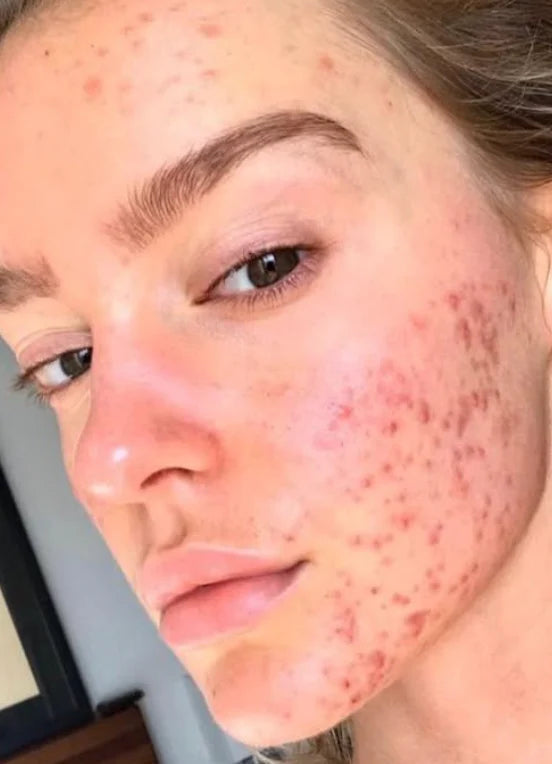 Rostro con acné severo antes del tratamiento granos visibles inflamación y rojez en la piel