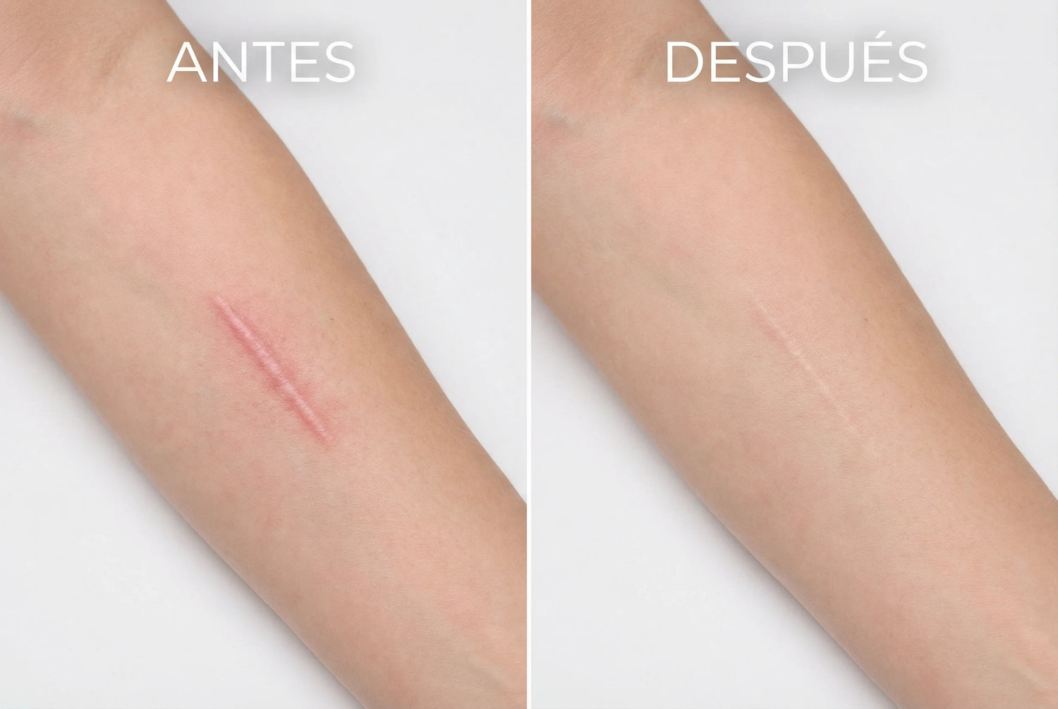 Antes y después de cicatriz en el brazo tras uso continuado del Stick de Silicona Médica - piel más uniforme y textura mejorada progresivamente