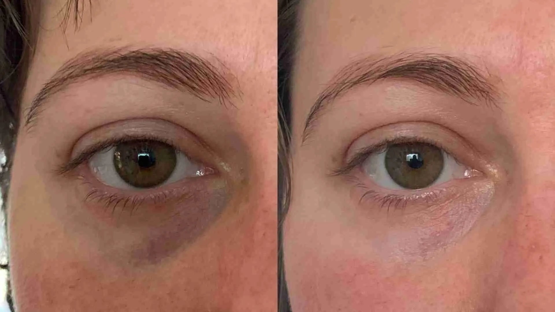 Resultados antes y después del contorno de ojos Dr.Melaxin mostrando reducción visible de ojeras y bolsas