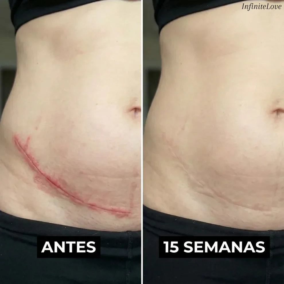 Antes y después del uso del Stick Reparador de Cicatrices con Silicona Médica - reducción visible de la apariencia de cicatrices tras uso continuado
