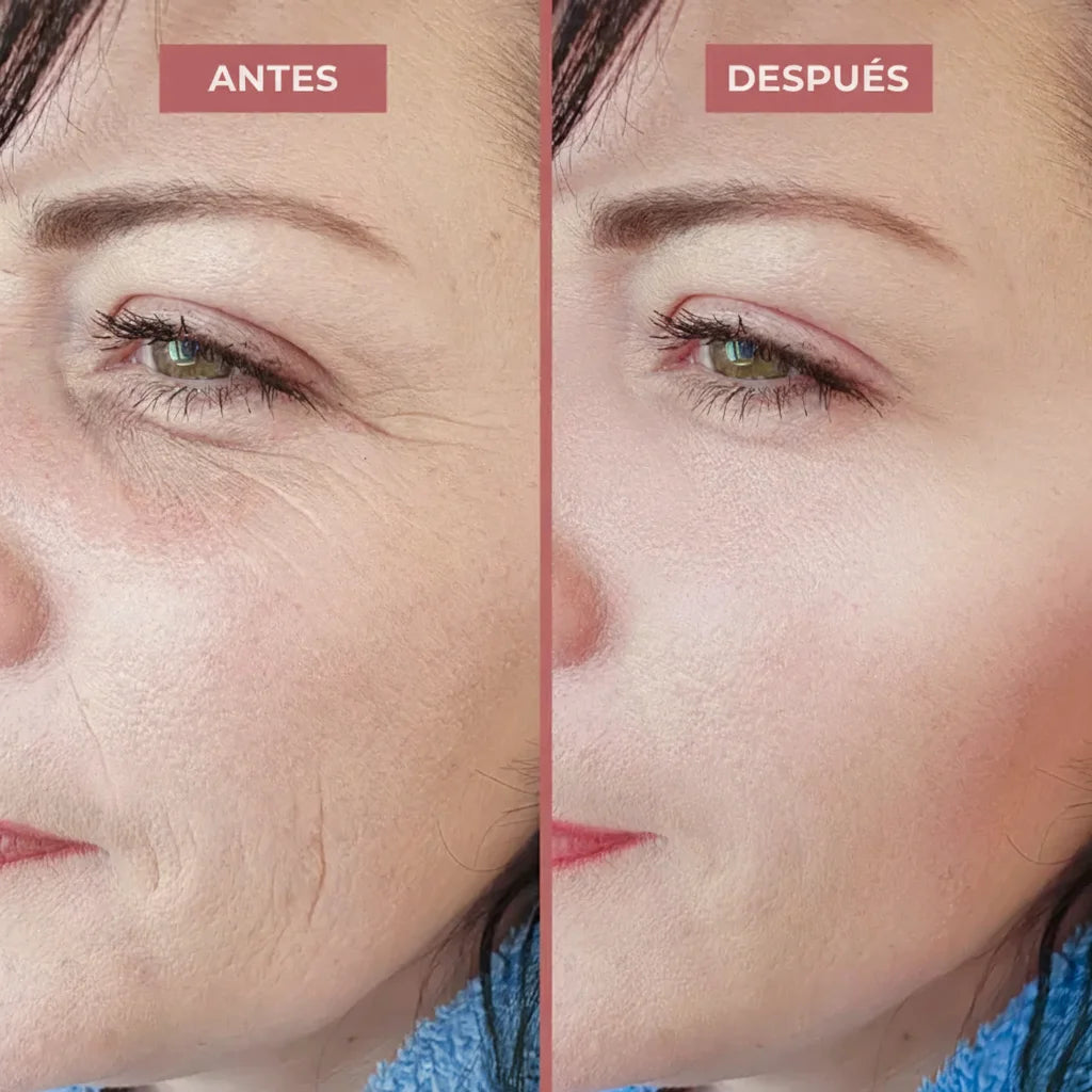 Comparativa antes y después del bálsamo Dr. Melaxin mostrando reducción de patas de gallo y líneas de expresión