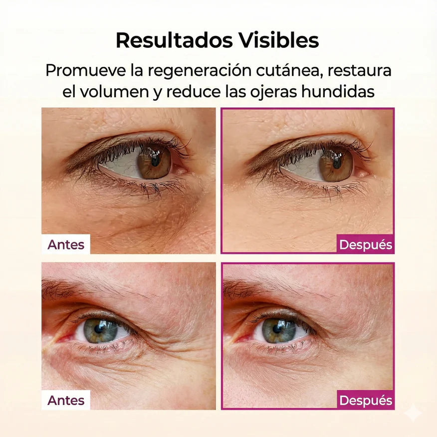Dr. Melaxin Cemenrete – resultados antes y después en reducción de ojeras hundidas y arrugas periorbitales