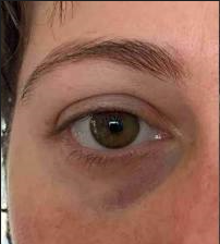 ANTES