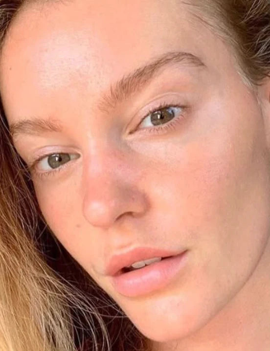 Rostro con piel limpia después del tratamiento reducción de granos rojez y mejora visible de la piel