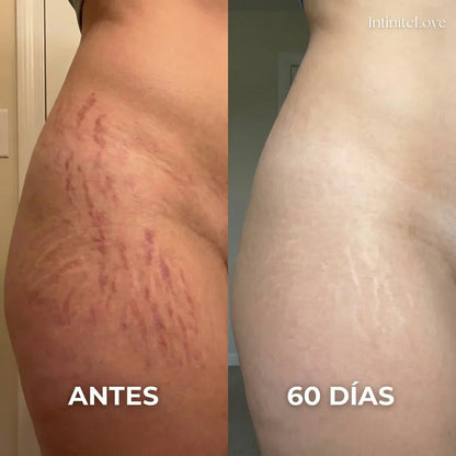 Resultado visible antes y después de aplicar el Stick de Silicona Médica para cicatrices - textura más suave y tono más uniforme con uso diario